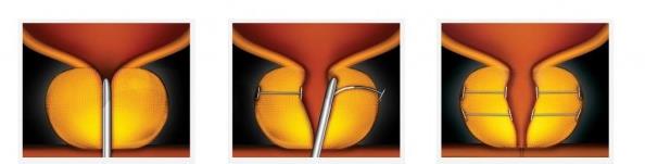 urolift illustration